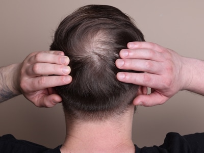 tratamento alopecia2