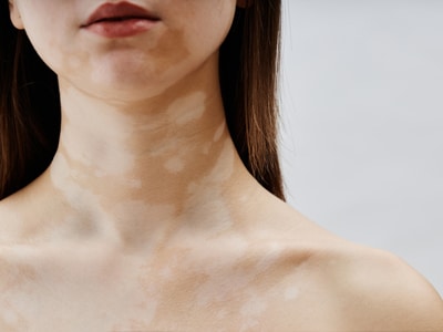 vitiligo